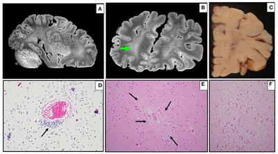 Neuropathology of Pediatric SARS-CoV-2 Infection in the Forensic Setting: Novel Application of Ex Vivo Imaging in Analysis of Brain Microvasculature